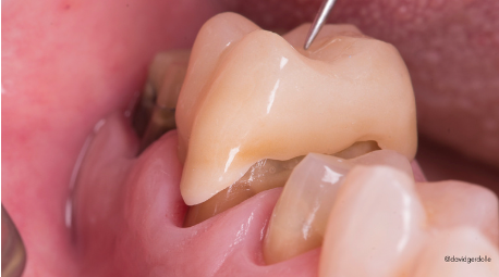 Clinical case: vertically finished margin