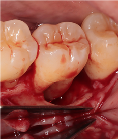 Clinical case: infrabony defect