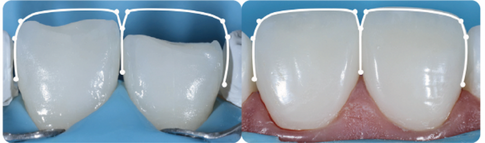 Direct anterior restorations: anatomy and line angles