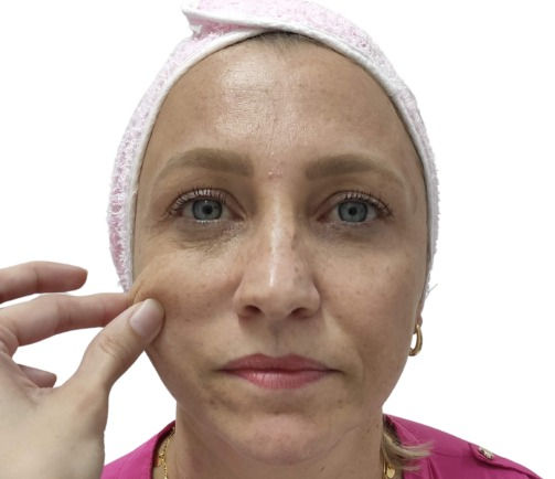Thumbnail: Collagen Stimulator - Consultation