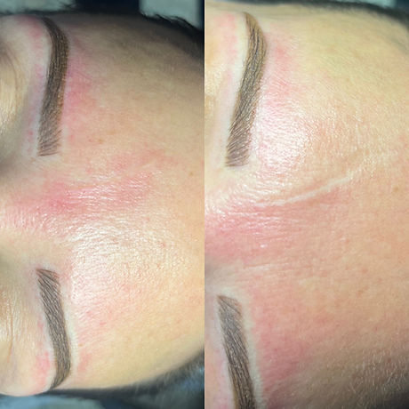 Forehead scar1.jpg