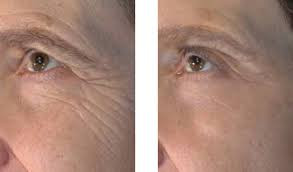 FACIAL MICRO-NEEDELING = A COLLAGEN INDUCTION THERAPY