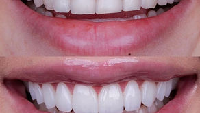 Quanto custa cada facetas de resina?