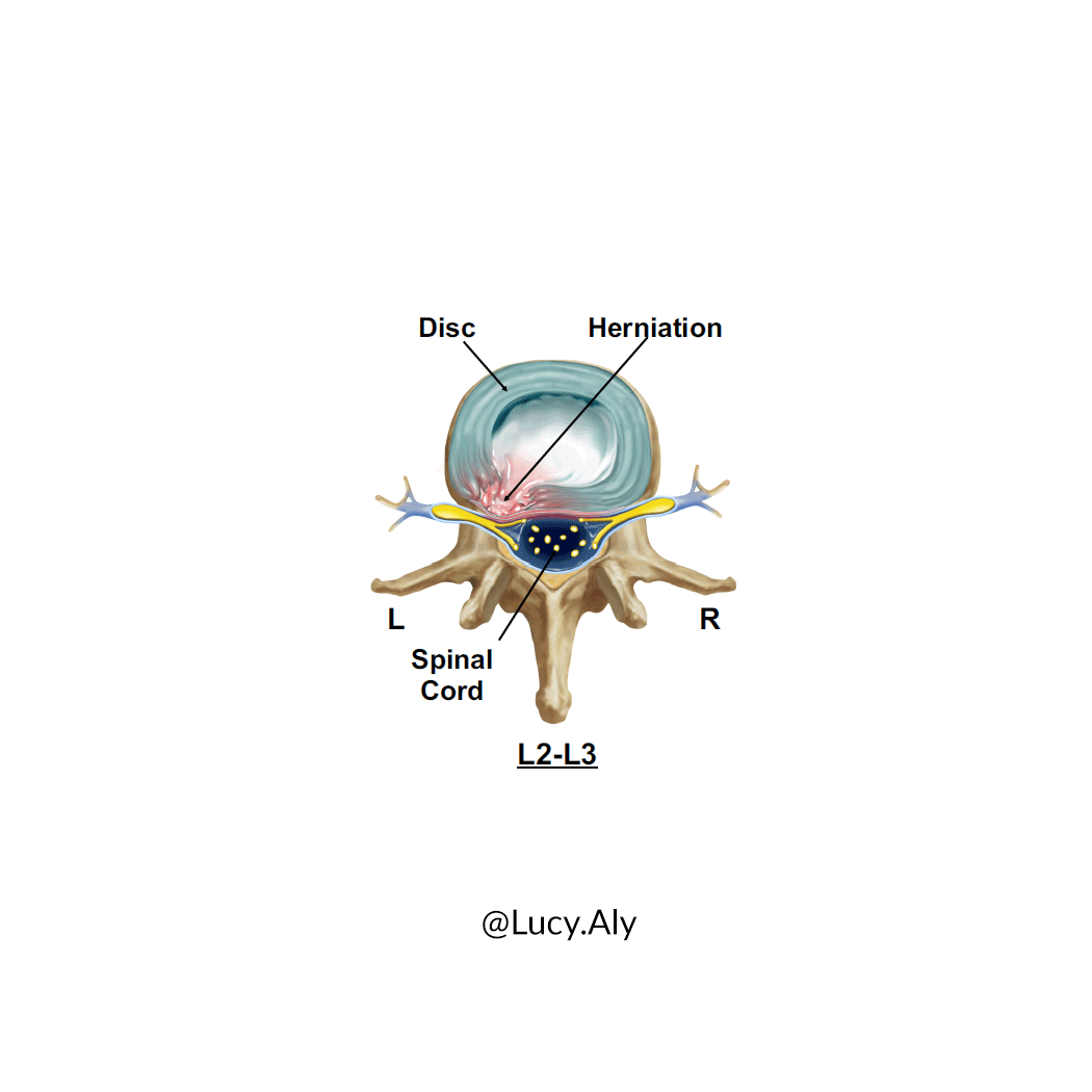 Cervical-Disc-Herniations_Lucy-Aly.gif