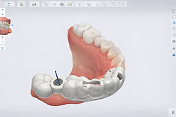Utilizzo di software per chirurgia guidata presso Nuovo Centro Medico Euganeo Studio dentistico a Battaglia Terme