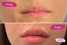 Prima e dopo filler labbra per migliorare forma e proporzioni presso Centro Medico Spinelli a Vicenza Veneto