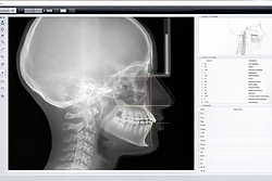 Analisi con software per cefalometria presso Nuovo Centro Medico Euganeo Studio dentistico a Battaglia Terme