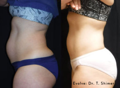 TS_EvolveTrim_Abdomen-300x220.jpg