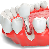 implante (1)_edited.png