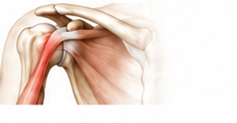 07_biceps_tendon_pain.png