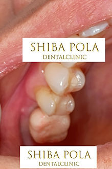 インプラント治療後|芝公園・田町・三田・赤羽橋の歯医者 芝ポーラ歯科