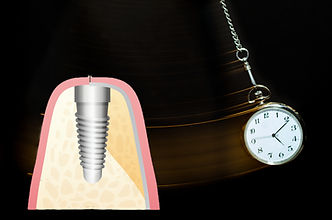 待機時間とインプラントの固定|芝公園・田町・三田・赤羽橋の歯医者 芝ポーラ歯科