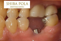 治癒後|芝公園・田町・三田・赤羽橋の歯医者 芝ポーラ歯科