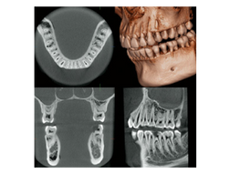 矯正歯科におけるCT診断で埋伏歯の位置と方向を精密に確認