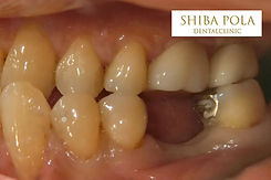 奥歯の欠損|芝公園・田町・三田・赤羽橋の歯医者 芝ポーラ歯科