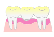 欠損補綴のメリットデメリット・ブリッジ|芝公園・田町・三田・赤羽橋の歯医者 芝ポーラ歯科