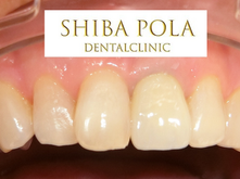 突然前歯がとれた!?