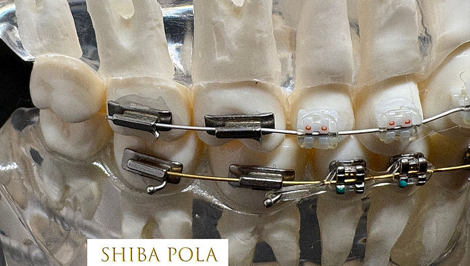 ワイヤー矯正・マウスピース矯正・小児矯正
大人も子供も始められる矯正治療について歯医者がやさしく解説。港区芝公園・赤羽橋・三田・田町で成人矯正をご検討の方へ。芝ポーラ歯科