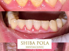 歯周病治療、歯石除去、スケーリング、定期健診｜港区芝公園・赤羽橋・三田・田町の歯医者｜芝ポーラ歯科