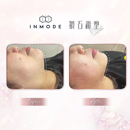 Dskin_Inmode_mini fx_療程前後