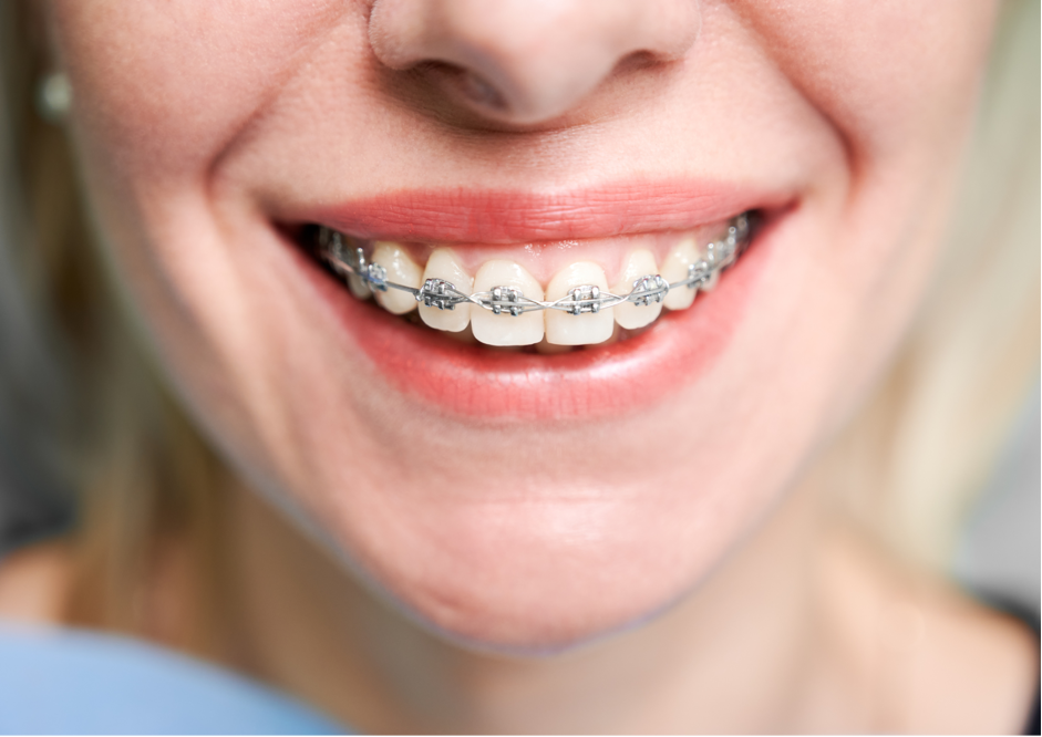 Combien de temps dure la pose d