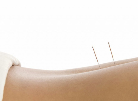 CONHEÇA A TÉCNICA DO DRY NEEDLING