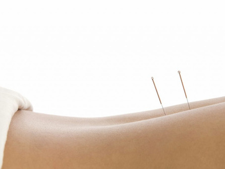 CONHEÇA A TÉCNICA DO DRY NEEDLING