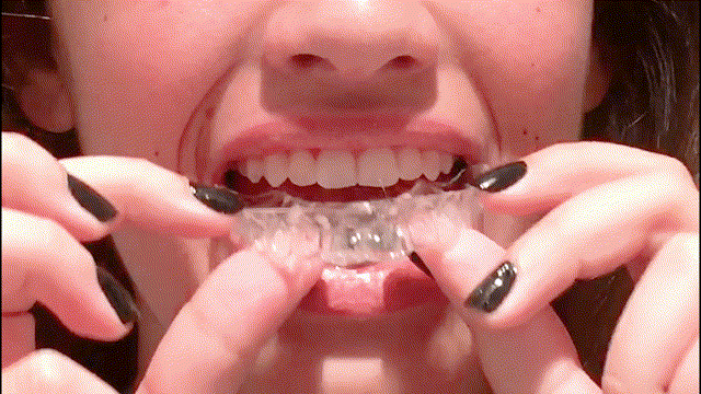 video protetor transparente dentev2 00_00_00-00_00_30.gif