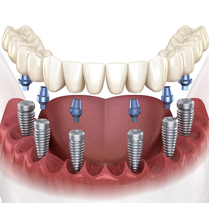 Bridge_Implant 2_edited.jpg