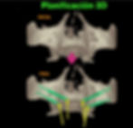 IMPLANTES CIGOMÁTICOS 1