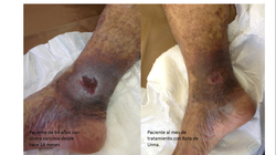ulcer