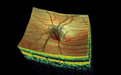 _ng_rachel__2215_Nerve%20Fiber%203D%20Disc_OS_2017-05-25_11-34-28_F_1994-05-25_Main%20Report_edited.
