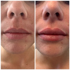 Juvederm