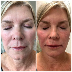 Juvederm