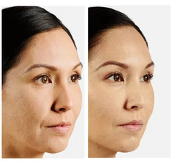 Juvederm
