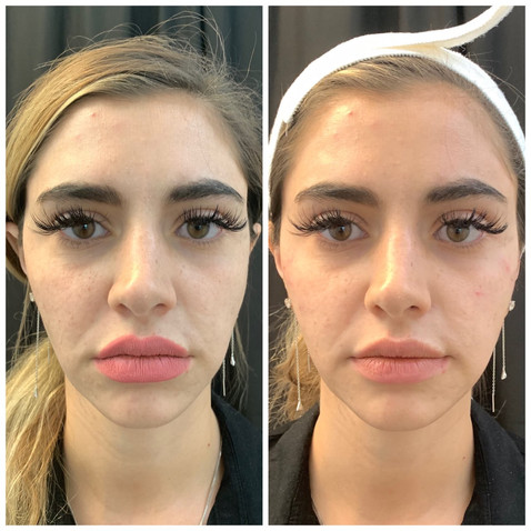 JUVEDERM