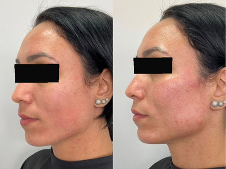 Sculptra, Radiesse e bioestimuladores: diferenças