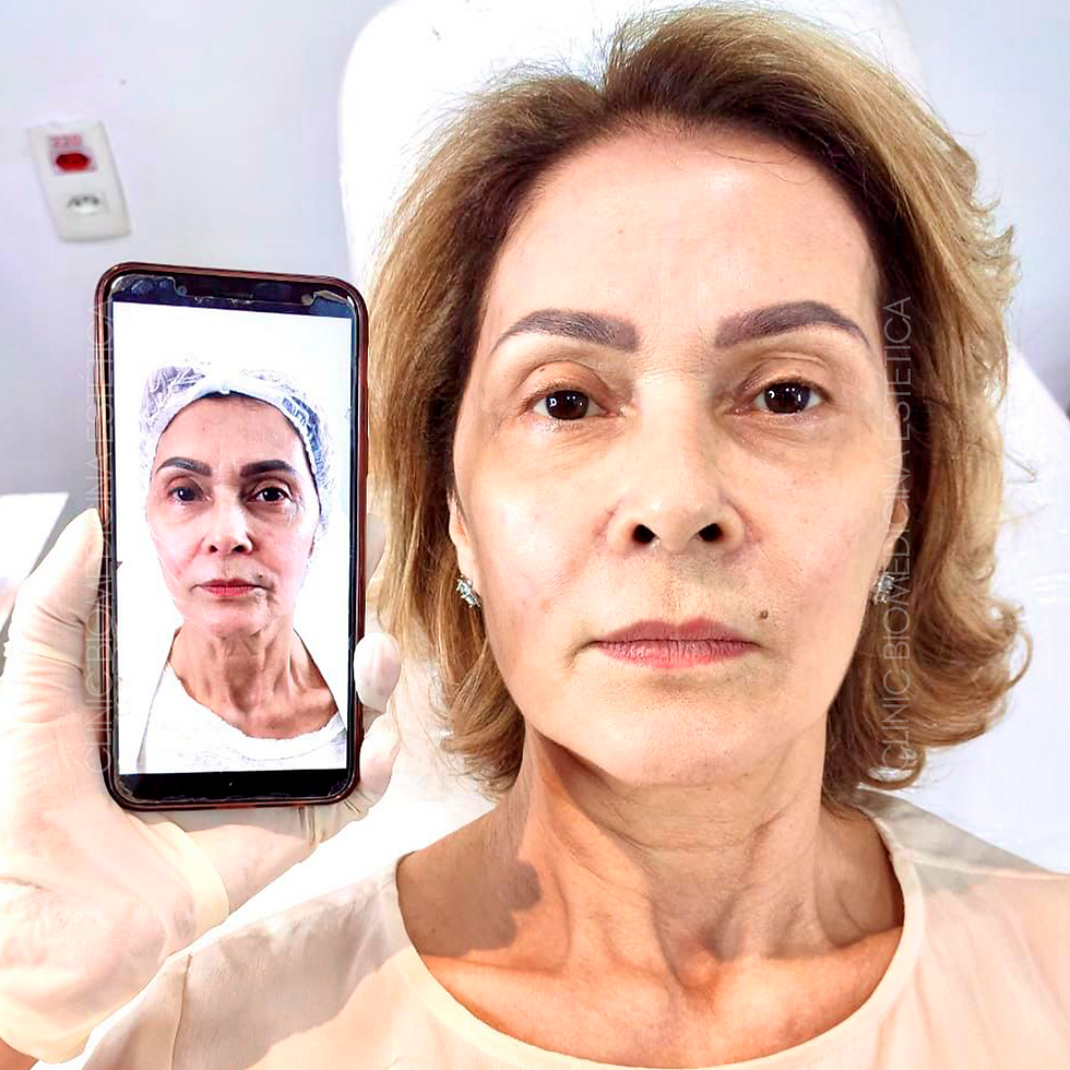 harmonizacao-facial