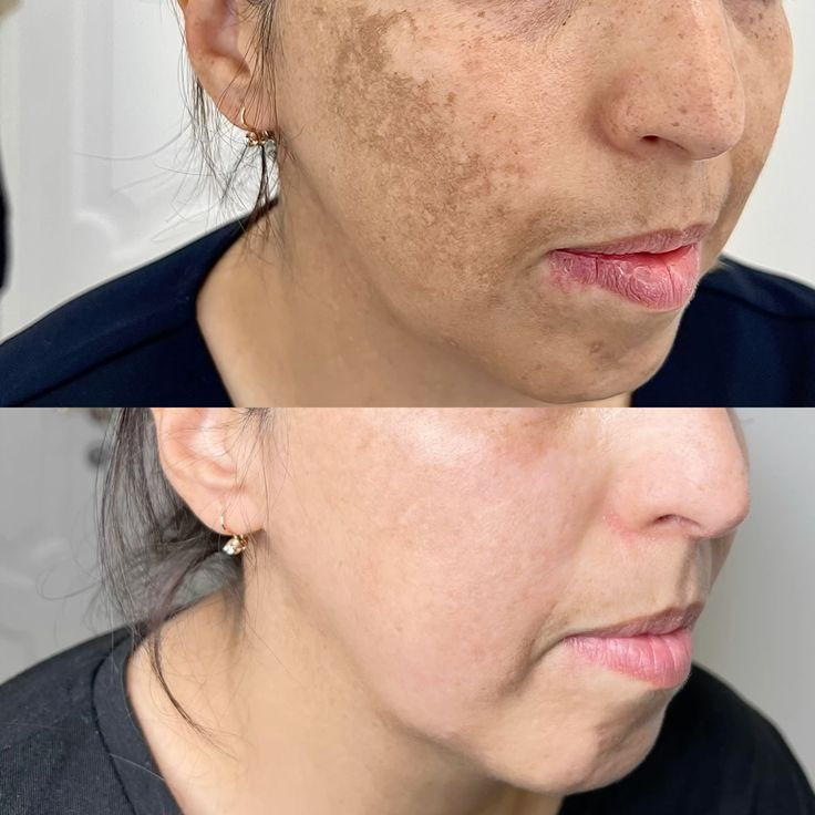 Miniatura: Tratamento para Melasma