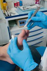 Treating ingrown toe nails