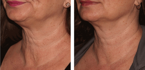 Before and After Sofwave treatment