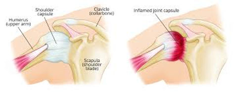 Frozen shoulder.jpeg