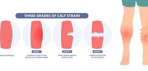 What is a calf strain? 