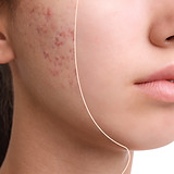 microneedling-acne-scars.jpeg