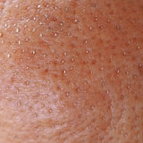 clogged-pores.jpeg