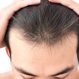 hair restoration
