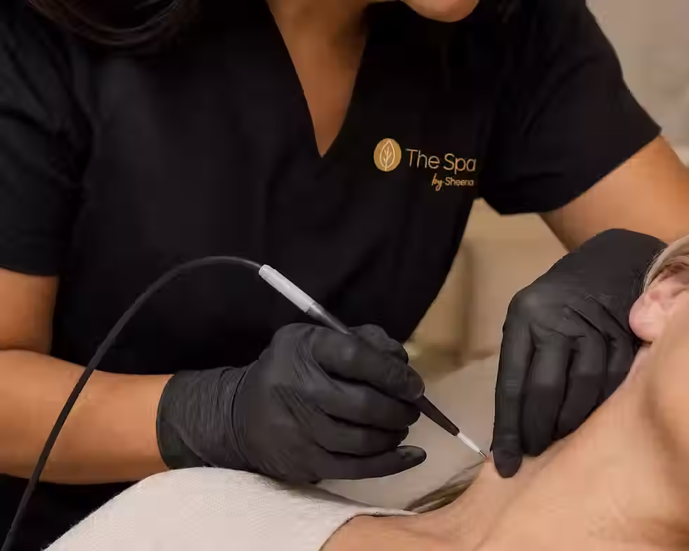 Provider using an electrocautery pen on a patient at The Spa by Sheena, a medical day spa in Lubbock, TX
