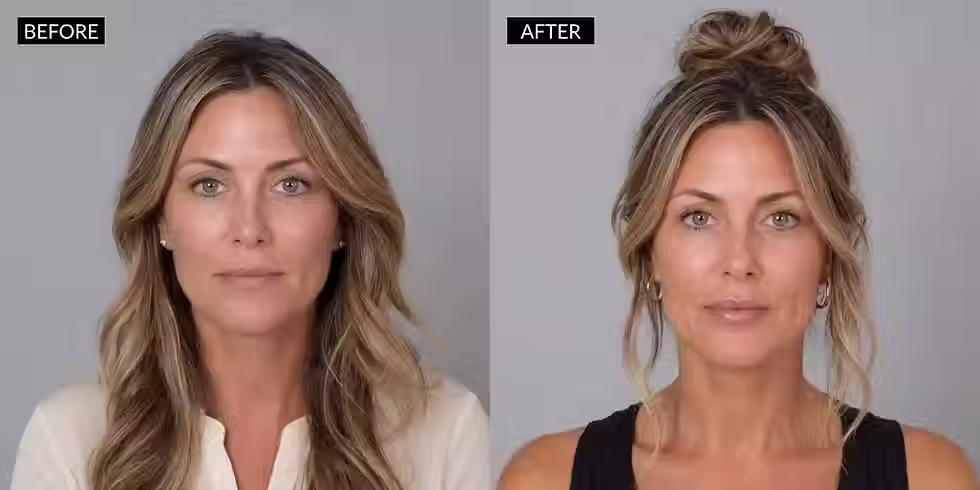 Before and After pictures of a lip filler with restylane kysse at the spa by sheena in lubbock, texas