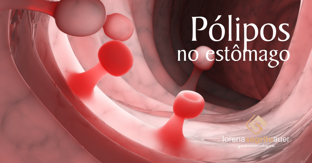 Pólipos no estômago Pólipos no estômago