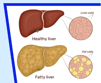 Fatty Liver: Penyebab, Gejala, dan Cara Mengatasinya Agar Tidak Semakin Parah